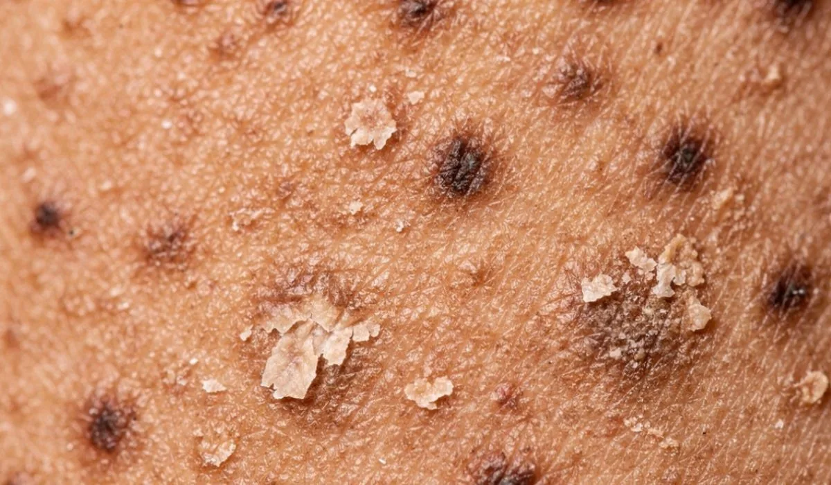 Dark Spots on Dry Skin