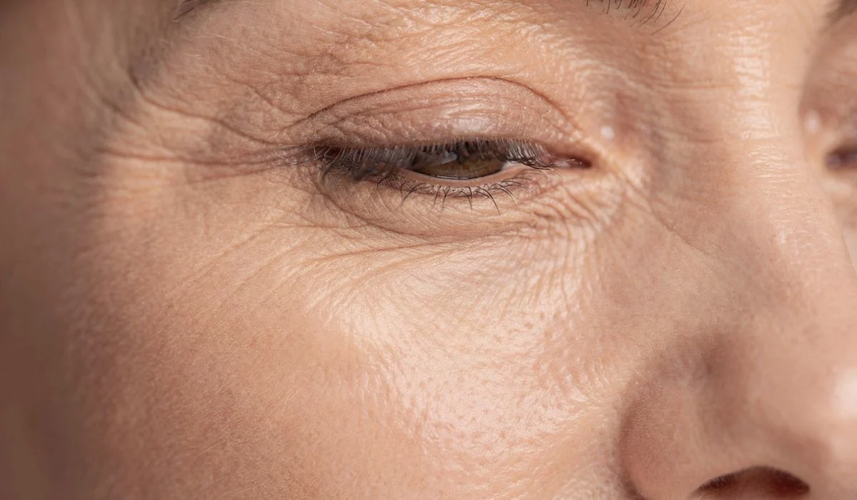 Under Eye Wrinkles